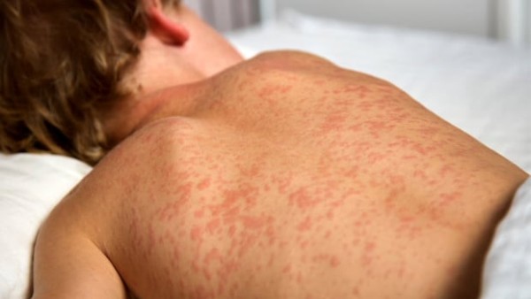اولین مورد سرخک در منطقه نورث‌وسترن تأیید شد؛ هشدار بهداشتی!